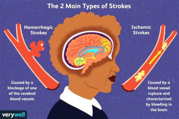 Do mini strokes make you tired?