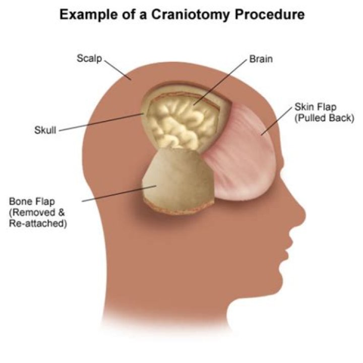 Do they put the skull back after brain surgery?