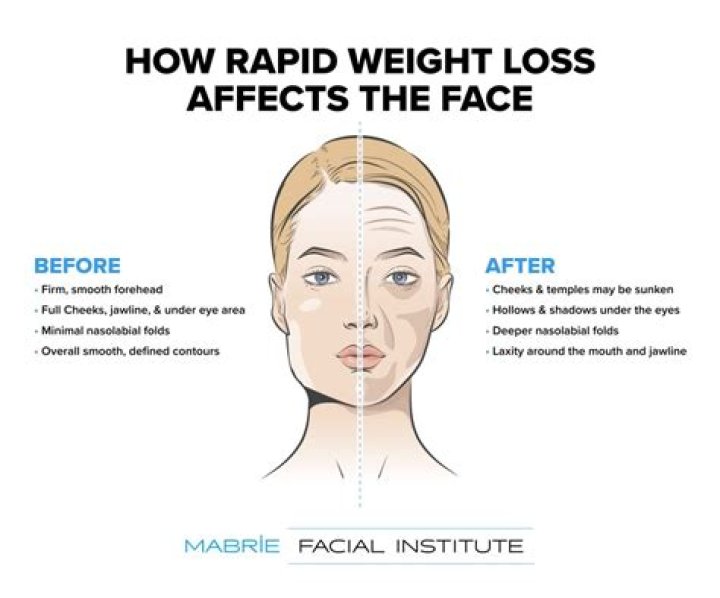 Does the face lose weight first?