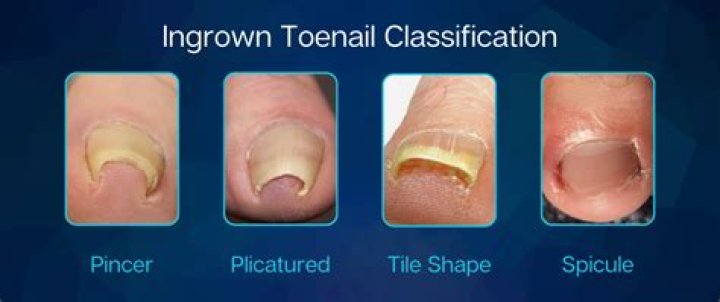 Should toenails be rounded or square?