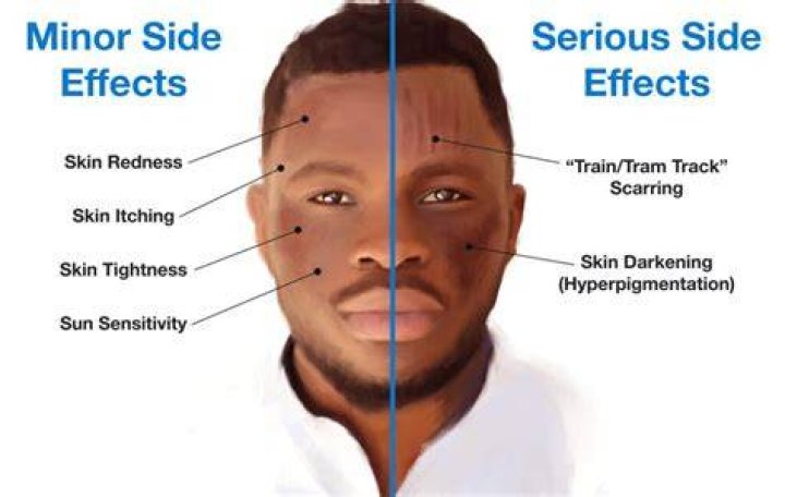 What are the side effects of microneedling?