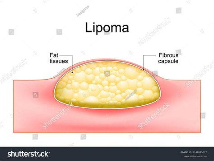 What is inside a lipoma?
