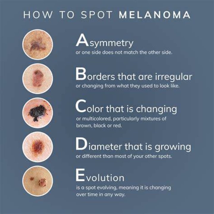 What looks like melanoma but isn t?