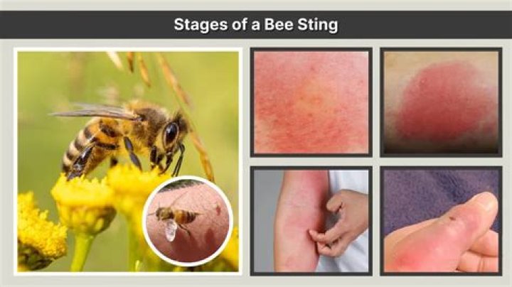 Why did my bee sting swell a day later?